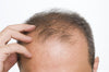 Hombre con alopecia androgénica mostrando pérdida de cabello frontal, ejemplo de lo que puede ocurrir al dejar de usar minoxidil